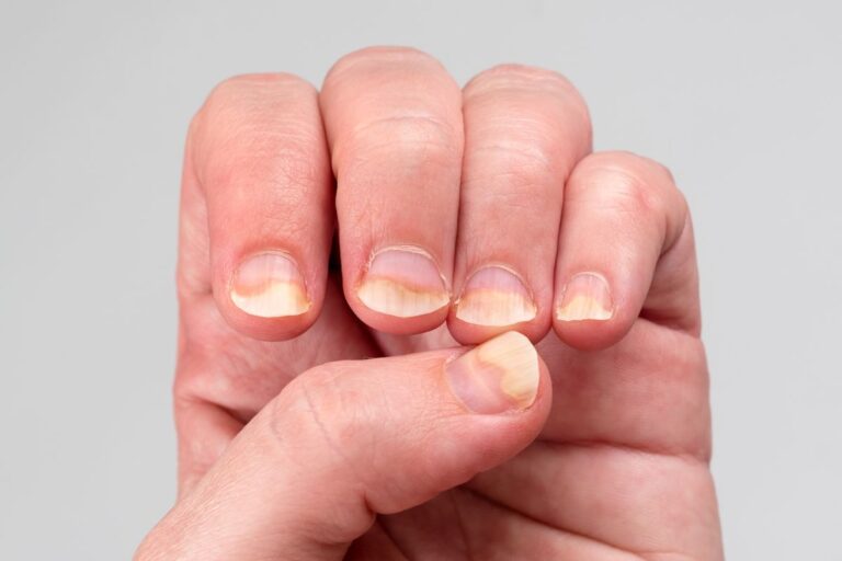 O que pode causar unhas amareladas